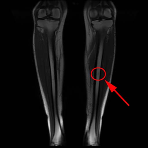 MR-undersökning 5 februari 2026 som visar benmärgsödem i tibia